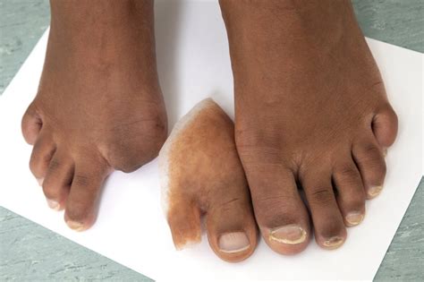 prosthetics for big toes amputated